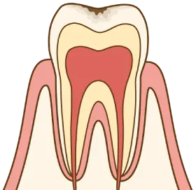 軽度の虫歯