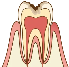 軽度の虫歯