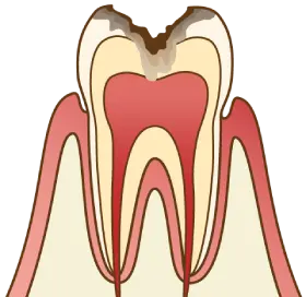 軽度の虫歯