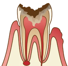 軽度の虫歯