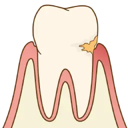 歯周炎
