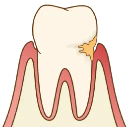 初期歯周炎