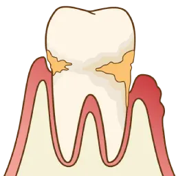 中程度歯周炎