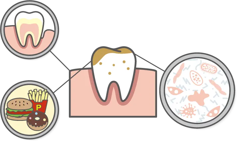 虫歯の原因