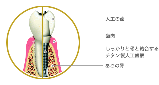 インプラント図式：人工の歯、歯茎、しっかりと骨と結合するチタン製人工歯根、あごの骨