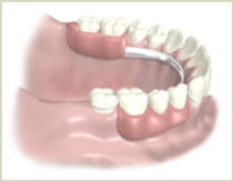 図：入れ歯