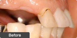 インプラント手術前の前歯