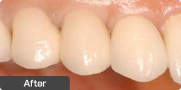 インプラント手術後の前歯：人工歯取付後