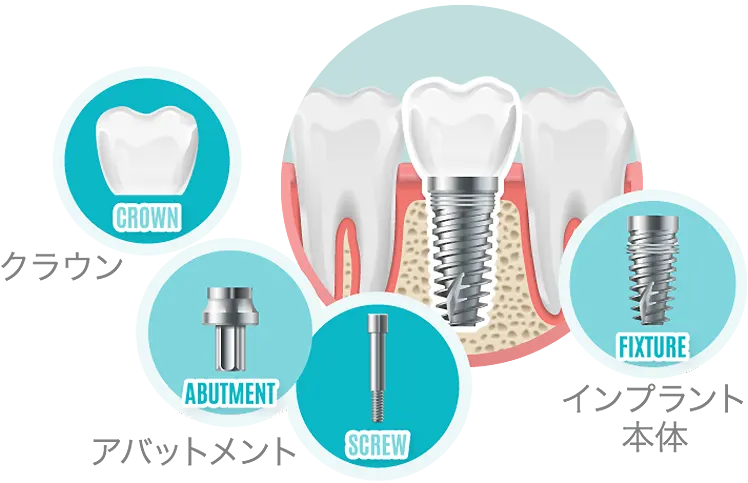 インプラントの構造