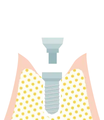 インプラント１回法の手術の流れ３