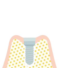 インプラント１回法の手術の流れ４