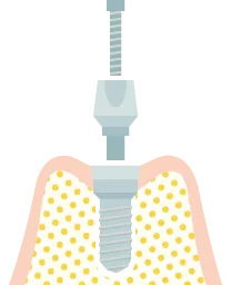 インプラント１回法の手術の流れ５