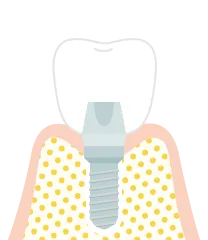 インプラント１回法の手術の流れ６