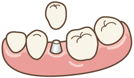 １本の欠損に対するインプラント治療