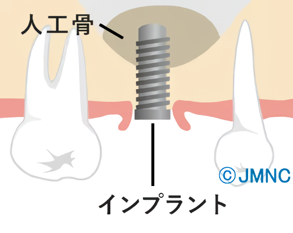 ソケットリフト