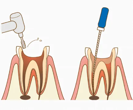 虫歯除去・抜髄・感染根管治療