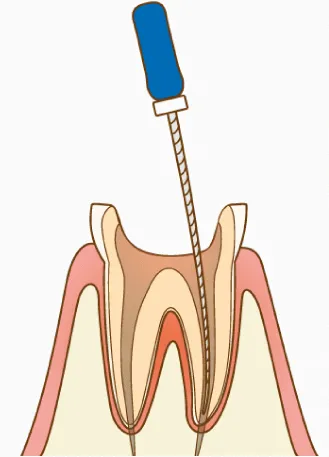 根管治療を繰り返す